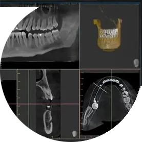 Rontgenstraling afbeelding 2 dentalpartnersrotterdam